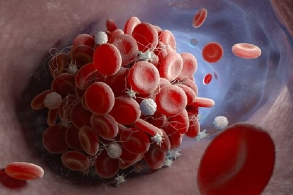 دانشمندان علت لخته شدن خون در بیماران کرونا را پیدا کردند